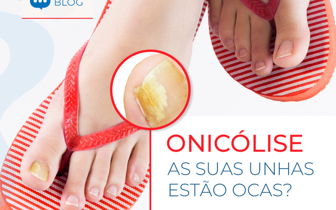 Onicólise – Unha oca