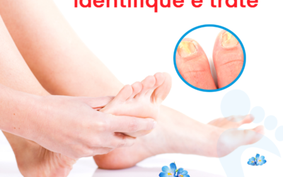 Onicomicose – Identifique e trate