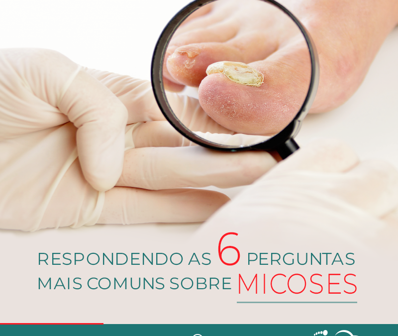 Onicomicose – Perguntas comuns