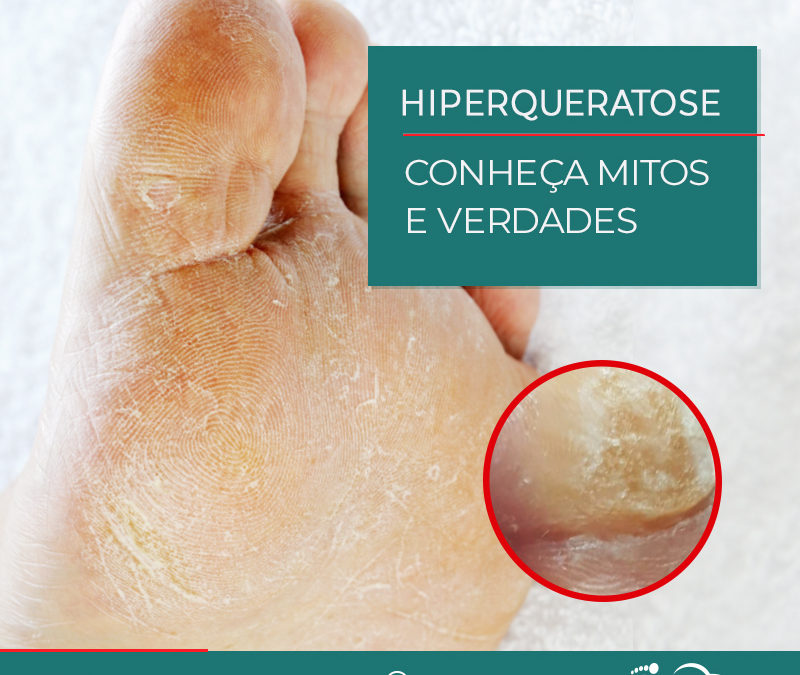 HIPERQUERATOSE – MITOS E VERDADES