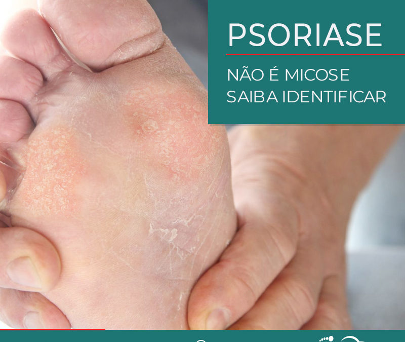 PSORÍASE NÃO É MICOSE