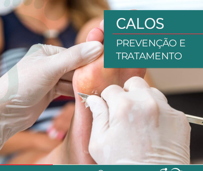 Calos – Tratamento e Prevenção