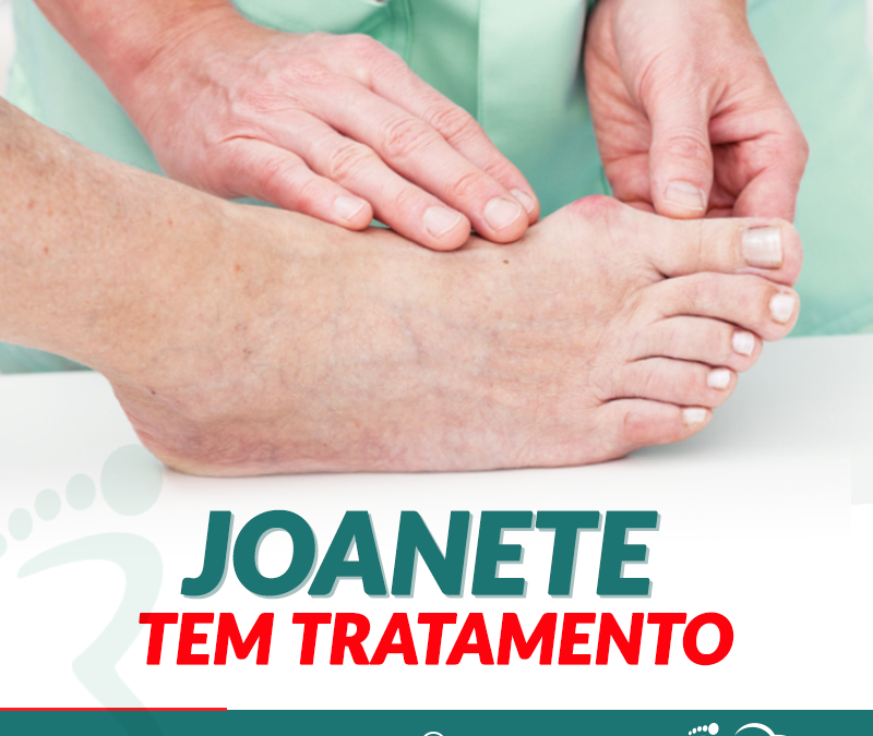 Joanete tem tratamento