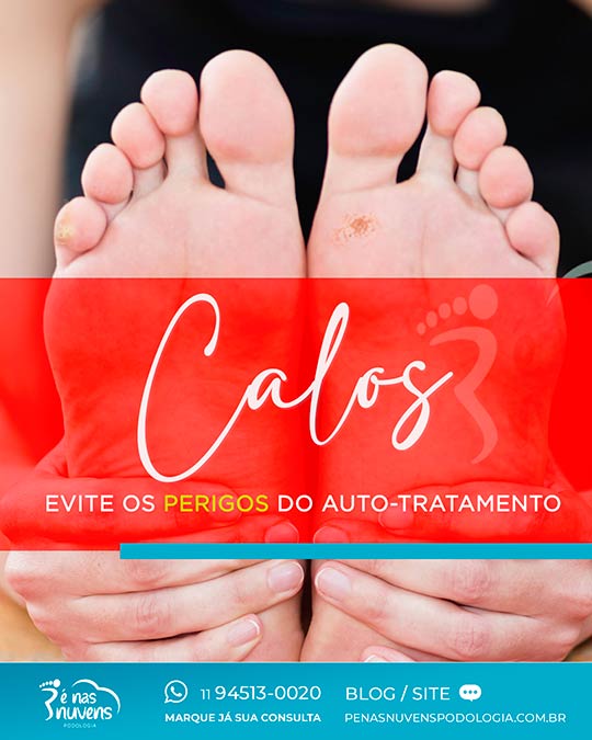 Calos e o perigo do auto-tratamento.