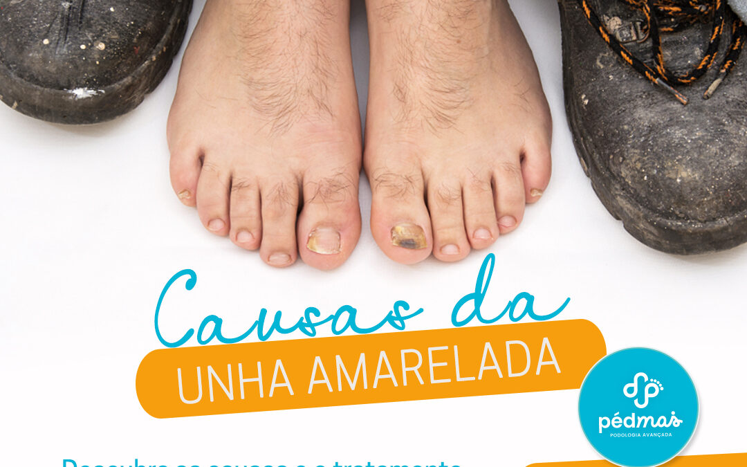 MANCHAS NAS UNHAS – CAUSA E TRATAMENTO