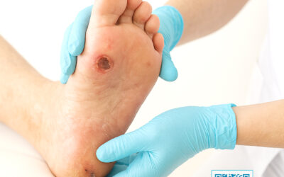 PÉS DIABÉTICOS – PEQUENOS DESCUIDOS VIRAM GRANDES COMPLICAÇÕES